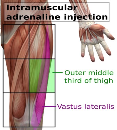 6 Grids Across the Upper Thigh Showing Injection Site.